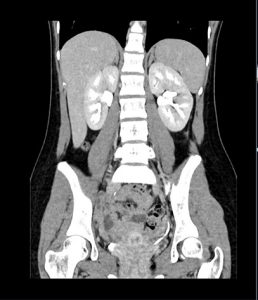 abdomen pelvis tomography computed