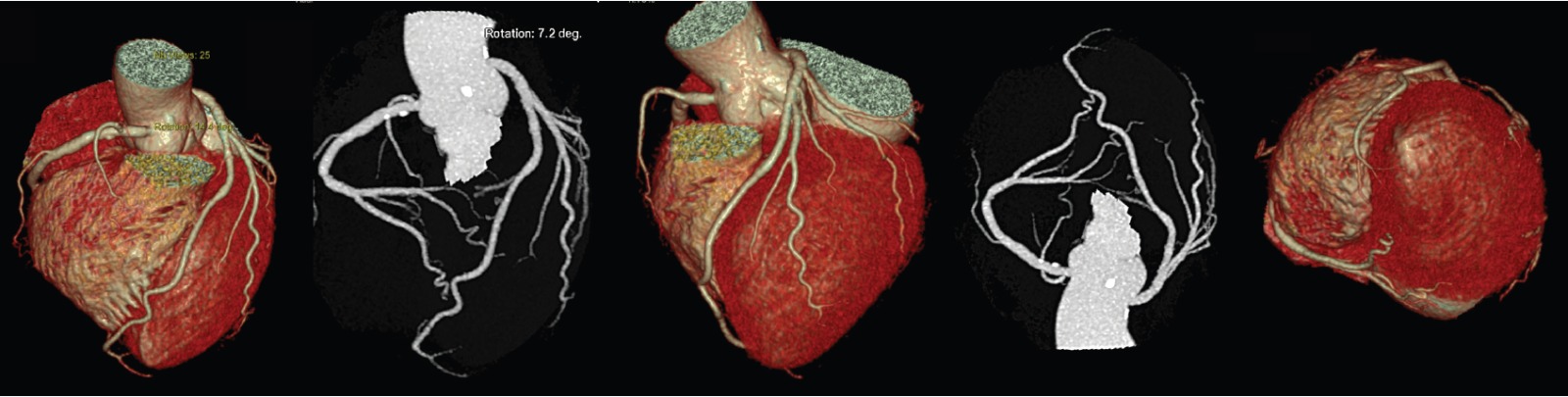 heart and blood vessels mri scan