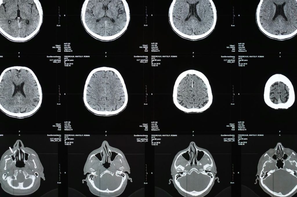 MRI Scans